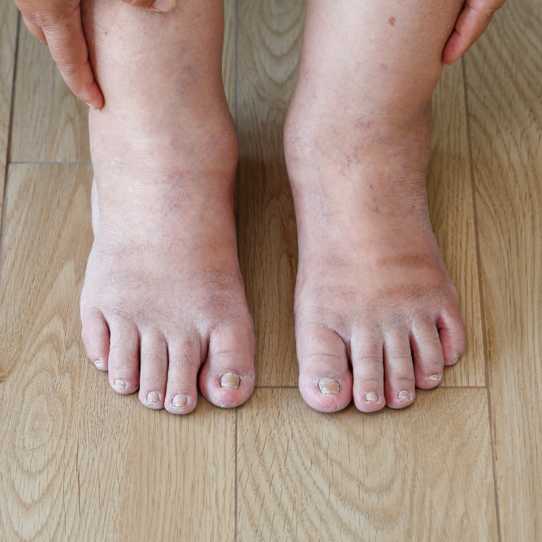 Bilde av de hovne beina til May Brit